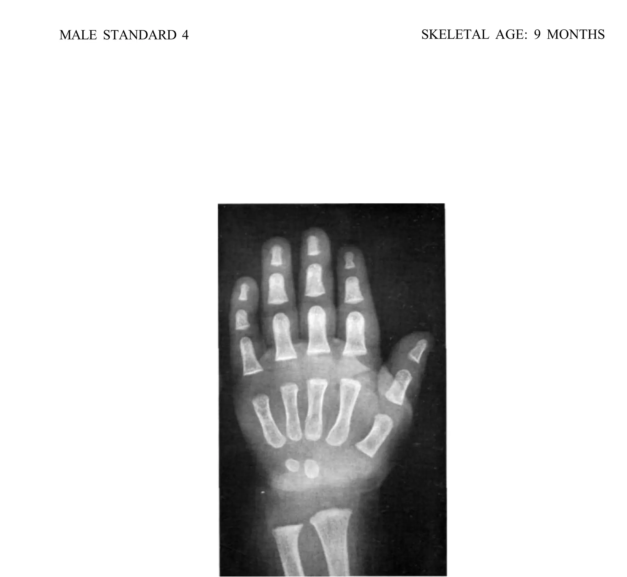 bone age atlas bone age atlas bone age atlas | PDF