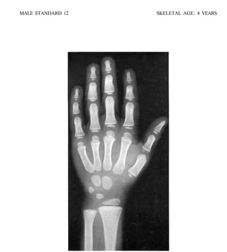 bone age atlas bone age atlas bone age atlas | PDF