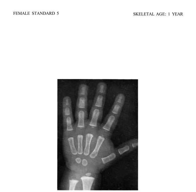 bone age atlas bone age atlas bone age atlas | PDF