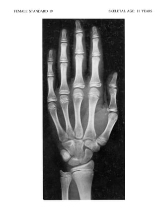 bone age atlas bone age atlas bone age atlas | PDF