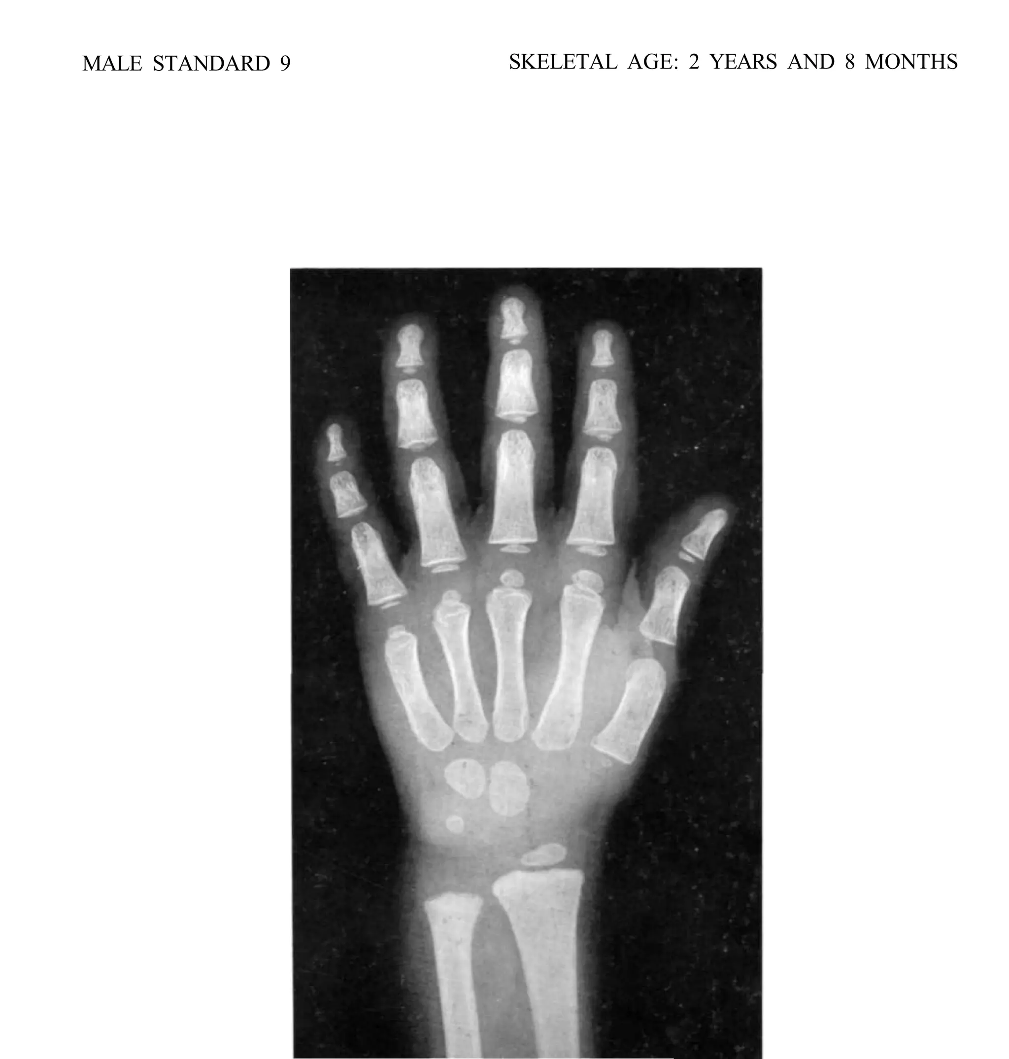 bone age atlasbone age atlas bone age atlas | PDF