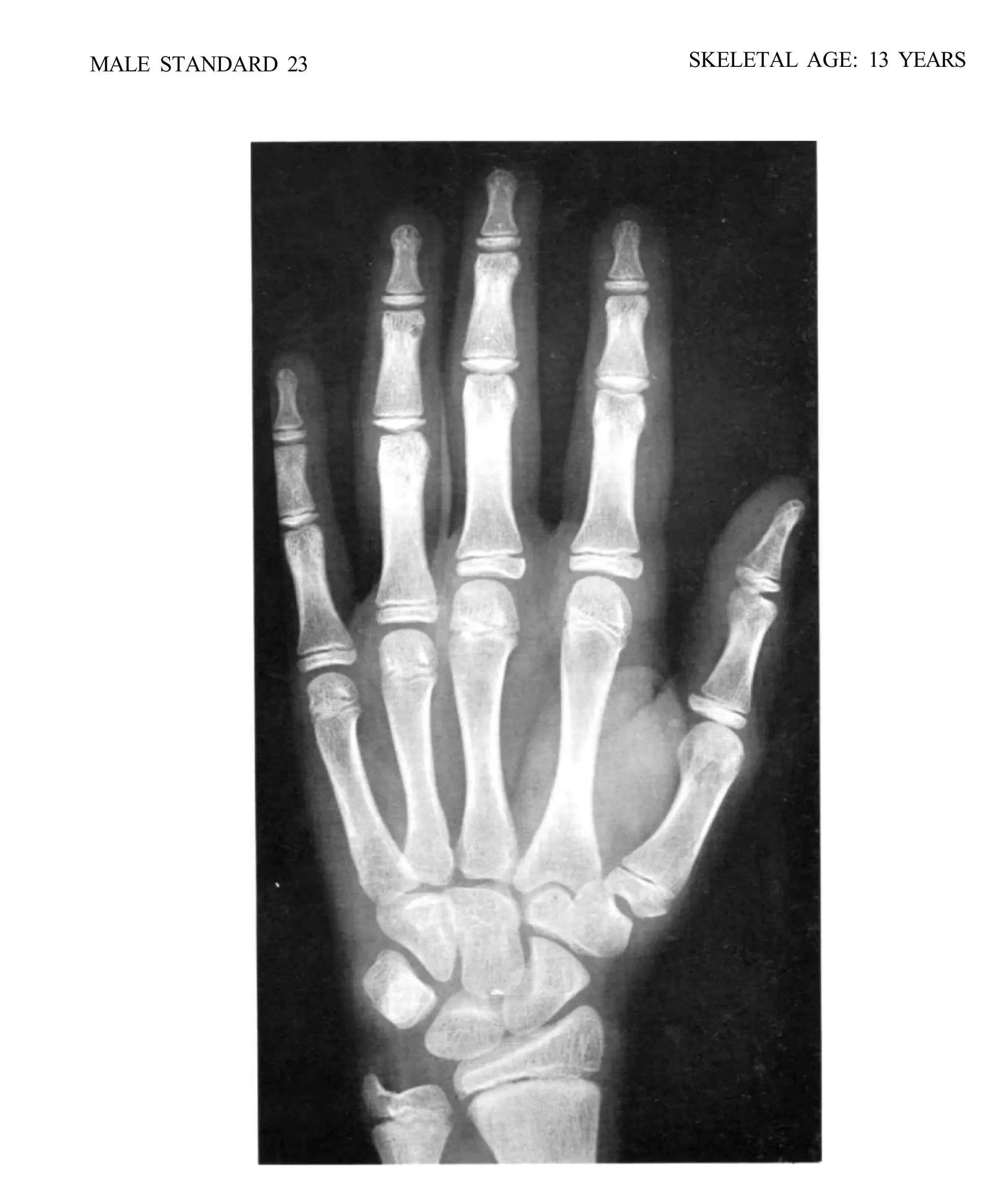 bone age atlasbone age atlas bone age atlas | PDF