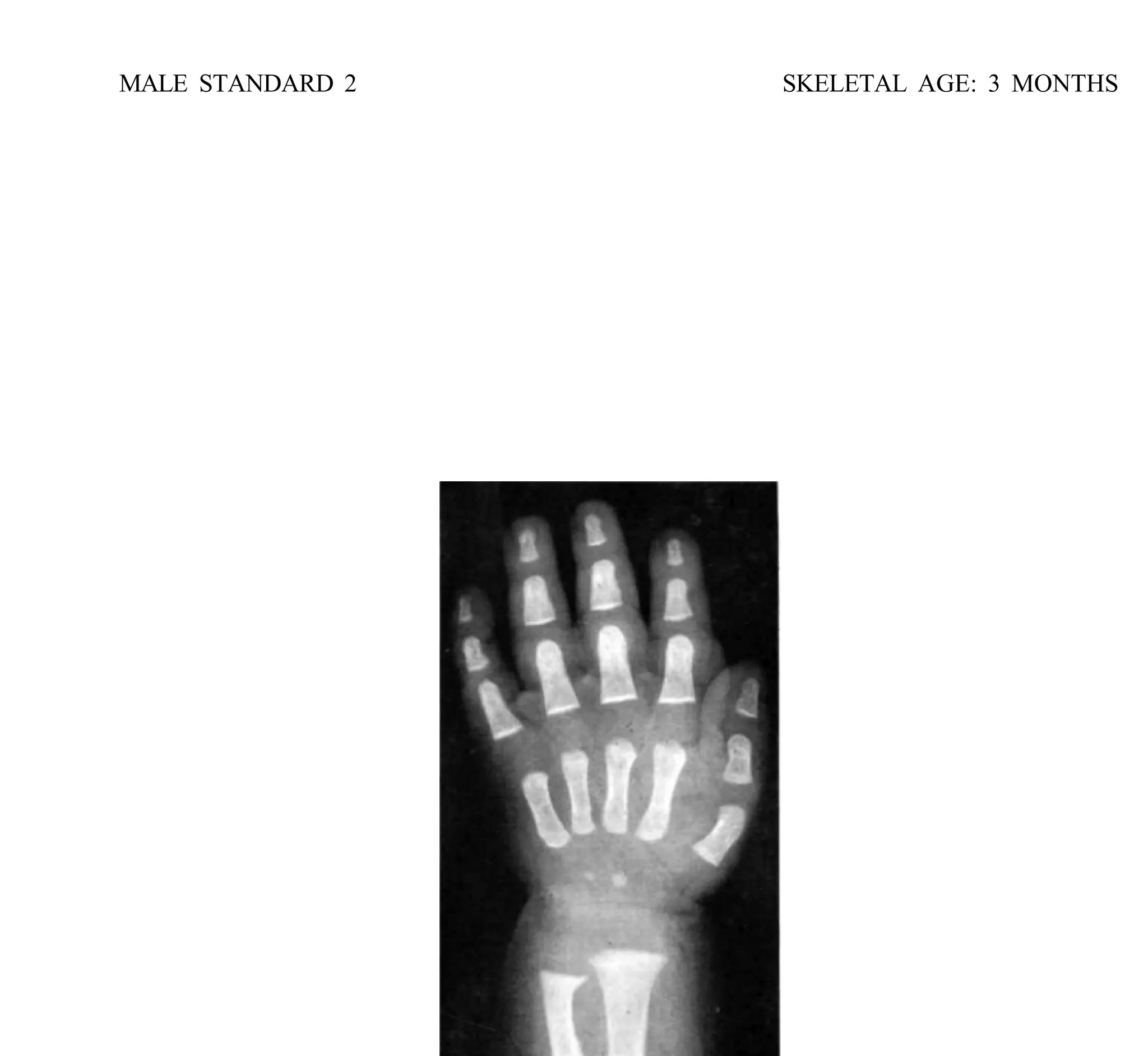 bone age atlasbone age atlas bone age atlas | PDF