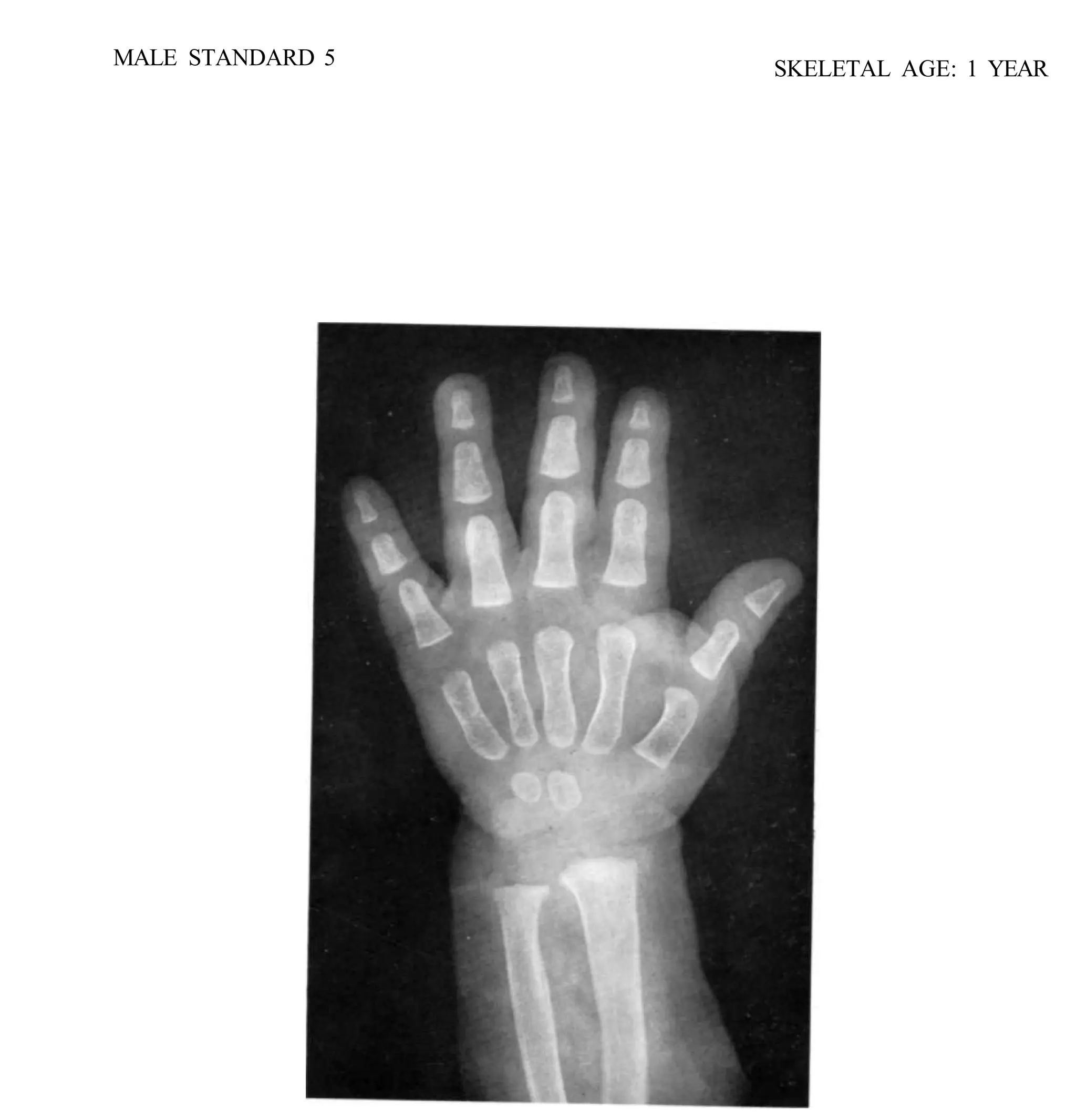 bone age atlasbone age atlas bone age atlas | PDF