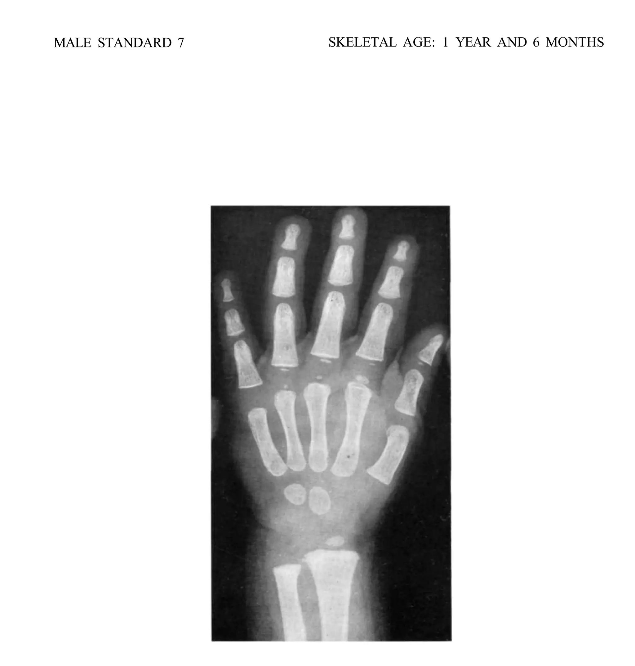 bone age atlasbone age atlas bone age atlas | PDF