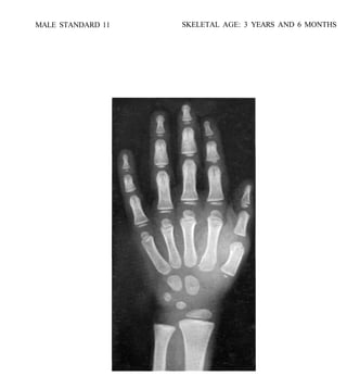 bone age atlasbone age atlas bone age atlas | PDF