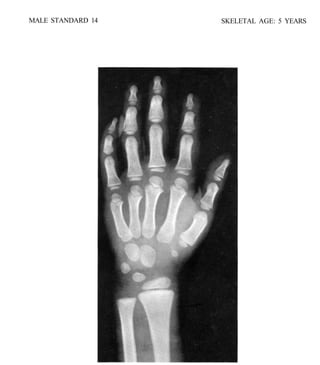 bone age atlasbone age atlas bone age atlas | PDF