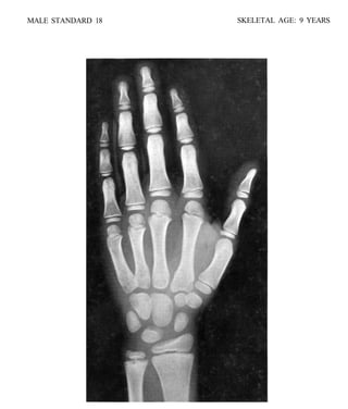bone age atlasbone age atlas bone age atlas | PDF