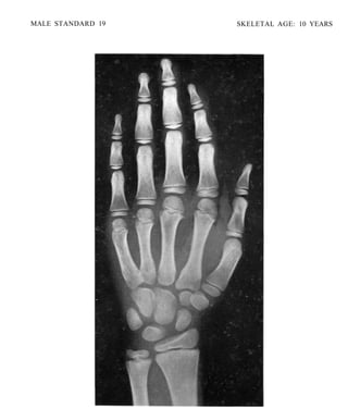 bone age atlasbone age atlas bone age atlas | PDF