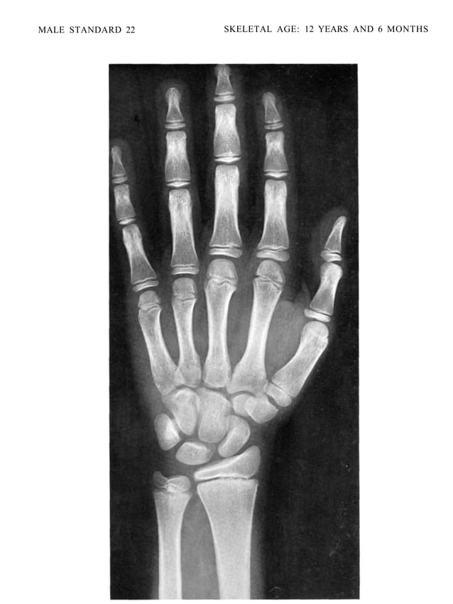bone age atlasbone age atlas bone age atlas | PDF