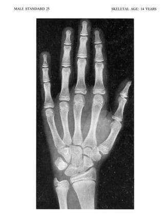 bone age atlasbone age atlas bone age atlas | PDF