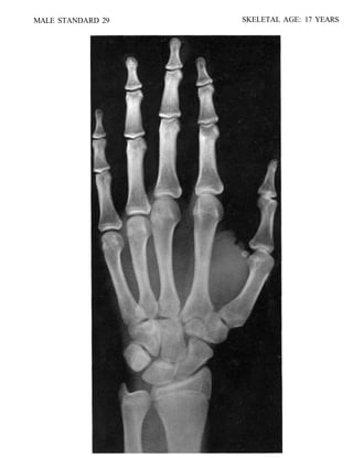 bone age atlasbone age atlas bone age atlas | PDF