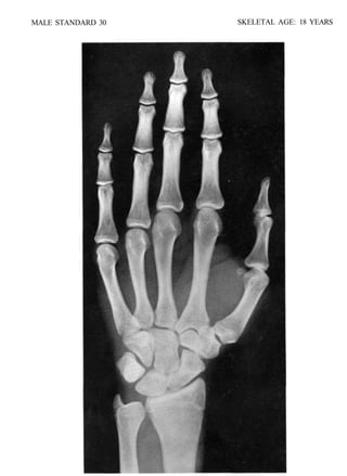 bone age atlasbone age atlas bone age atlas | PDF