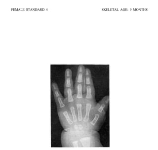 Process Update Slide Design bone age atlasbone age atlas bone age atlas | PDF