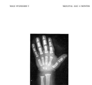 bone age atlasbone age atlas bone age atlas | PDF