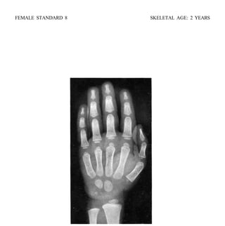 bone age atlasbone age atlas bone age atlas | PDF