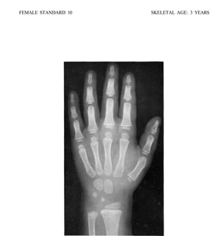 bone age atlasbone age atlas bone age atlas | PDF