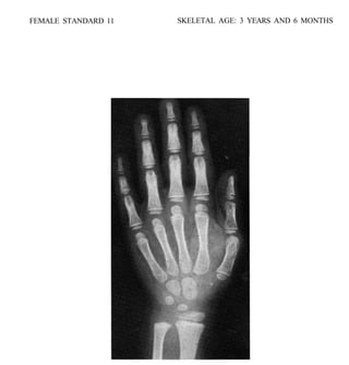 bone age atlasbone age atlas bone age atlas | PDF