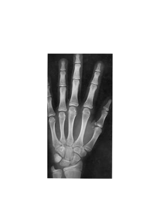 bone age atlasbone age atlas bone age atlas | PDF