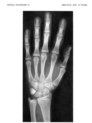 bone age atlasbone age atlas bone age atlas | PDF