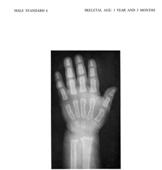 bone age atlasbone age atlas bone age atlas | PDF