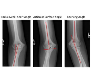 Radial Neck- Shaft Angle Articular Surface Angle Carrying Angle
 