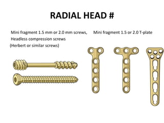 RADIAL HEAD #
Mini fragment 1.5 mm or 2.0 mm screws, Mini fragment 1.5 or 2.0 T-plate
Headless compression screws
(Herbert or similar screws)
 