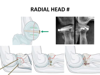 RADIAL HEAD #
 