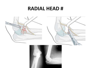 RADIAL HEAD #
 
