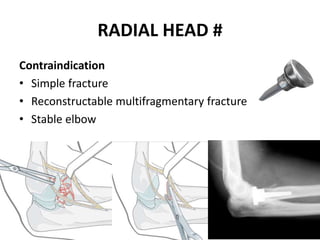 RADIAL HEAD #
Contraindication
• Simple fracture
• Reconstructable multifragmentary fracture
• Stable elbow
 