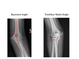 Baumann angle Trochlear Notch Angle
 