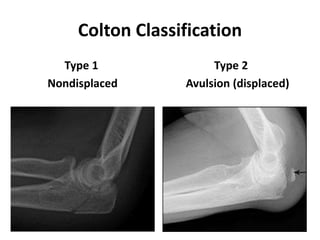 Colton Classification
Type 1 Type 2
Nondisplaced Avulsion (displaced)
 