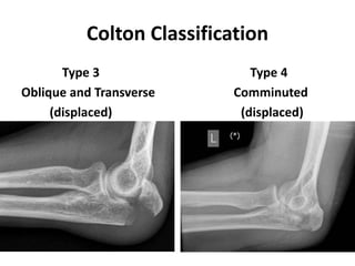 Colton Classification
Type 3 Type 4
Oblique and Transverse Comminuted
(displaced) (displaced)
 