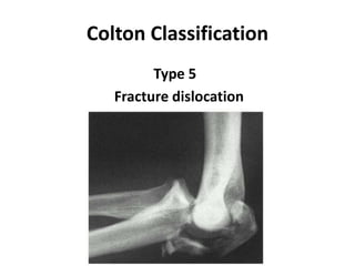 Colton Classification
Type 5
Fracture dislocation
 