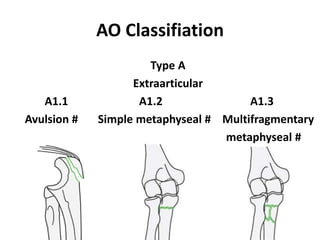 AO Classifiation
Type A
Extraarticular
A1.1 A1.2 A1.3
Avulsion # Simple metaphyseal # Multifragmentary
metaphyseal #
 
