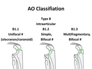 AO Classifiation
Type B
Intraarticular
B1.1 B1.2 B1.3
Unifocal # Simple, Multifragmentary,
(olecranon/coronoid) Bifocal # Bifocal #
 