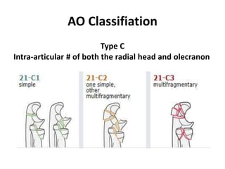 AO Classifiation
Type C
Intra-articular # of both the radial head and olecranon
 