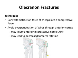 Olecranon Fractures
Technique:
• Converts distraction force of triceps into a compressive
force
• Avoid overpenetration of wires through anterior cortex
– may injury anterior interosseous nerve (AIN)
– may lead to decreased forearm rotation
 
