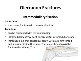 Olecranon Fractures
Intramedullary fixation
Indications
• transverse fracture with no comminution
Technique
• can be combined with tension banding
• intramedullary screw must engage distal intramedullary canal
• Introduce a 6.5 mm cancellous screw with a 32 mm thread
and a washer inside the canal. The screw should cross the
fracture site at least 7cm.
 