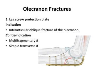 Olecranon Fractures
1. Lag screw protection plate
Indication
• Intraarticular oblique fracture of the olecranon
Contraindication
• Multifragmentary #
• Simple transverse #
 