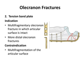 Olecranon Fractures
2. Tension band plate
Indication
• Multifragmentary olecranon
fracture in which articular
surface is intact
• More distal olecranon
fractures
Contraindication
• Multifragmentation of the
articular surface
 