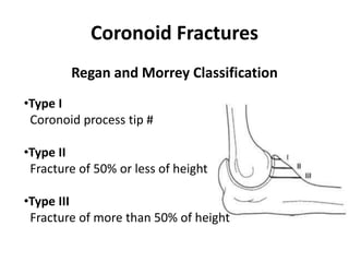 Coronoid Fractures
Regan and Morrey Classification
•Type I
Coronoid process tip #
•Type II
Fracture of 50% or less of height
•Type III
Fracture of more than 50% of height
 