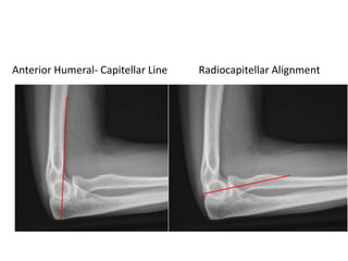 Anterior Humeral- Capitellar Line Radiocapitellar Alignment
 