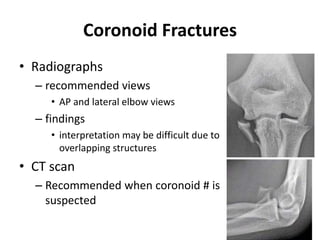 Coronoid Fractures
• Radiographs
– recommended views
• AP and lateral elbow views
– findings
• interpretation may be difficult due to
overlapping structures
• CT scan
– Recommended when coronoid # is
suspected
 