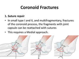 Coronoid Fractures
1. Suture repair
• In small type I and II, and multifragmentary, fractures
of the coronoid process, the fragments with joint
capsule can be reattached with sutures
• This requires a Medial approach.
 