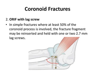 Coronoid Fractures
2. ORIF with lag screw
• In simple fractures where at least 50% of the
coronoid process is involved, the fracture fragment
may be reinserted and held with one or two 2.7 mm
lag screws.
 