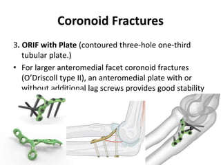 Coronoid Fractures
3. ORIF with Plate (contoured three-hole one-third
tubular plate.)
• For larger anteromedial facet coronoid fractures
(O’Driscoll type II), an anteromedial plate with or
without additional lag screws provides good stability
 