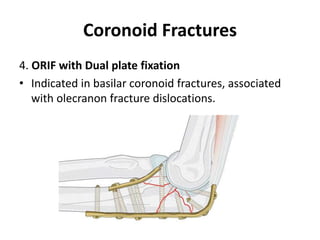 Coronoid Fractures
4. ORIF with Dual plate fixation
• Indicated in basilar coronoid fractures, associated
with olecranon fracture dislocations.
 