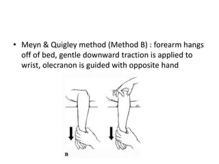 • Meyn & Quigley method (Method B) : forearm hangs
off of bed, gentle downward traction is applied to
wrist, olecranon is guided with opposite hand
 