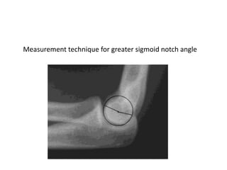 Measurement technique for greater sigmoid notch angle
 